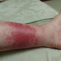 Exercise-induced vasculitis
More severe