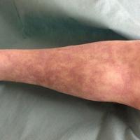 
	Livedo reticularis

	As well as occuring in…