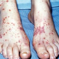 
	Small vessel vasculitis secondary to systemic…