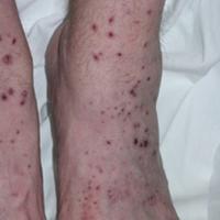 
	Microscopic polyangiitis causing palpable…