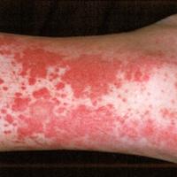 
	Vasculitic urticaria secondary to microscopic…
