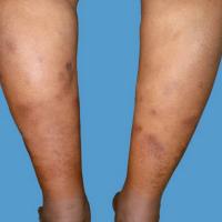 
	Nodular vasculitis