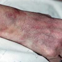 
	PAN (systemic) and livedo reticularis 