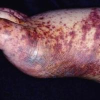 
	Retiform purpura

	A reticular (net-like)…