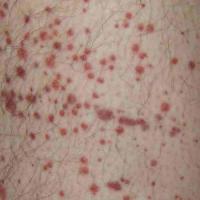 
	Scurvy - not vasculitis&nbsp;

	Red papules…