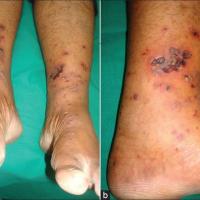 
	Vasculitis secondary to carbamazepine