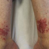 
	Exercise-induced vasculitis - secondary to…