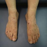 
	Waldenstrom's hypergammaglobulinaemic…