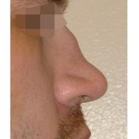 
	Wegener&rsquo;s granulomatosis
