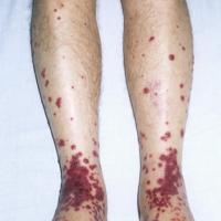 
	Wegener&rsquo;s granulomatosis causing palpable…