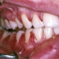 
	Wegener&rsquo;s granulomatosis

	Gingivitis…