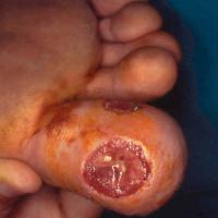 
	Wegener&rsquo;s granulomatosis causing…