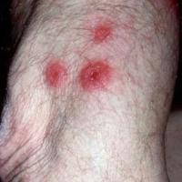 
	Same patient as previous image - granulomatous…