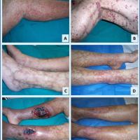 
	Cryoglobulinaemia 

	Physical signs include…
