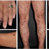 
	Cryoglobulinaemic vasculitis in a patient with…
