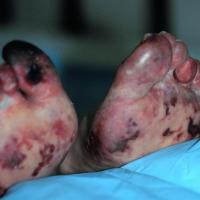 
	Emboli (not vasculitis)