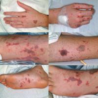 
	Meningococcal septicaemia - causing a septic…
