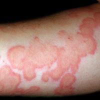 
	Urticarial vasculitis

	Individual lesions…