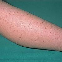 
	Waldenstrom's hypergammaglobulinaemic…