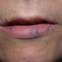 
	Venous lakes on the lips