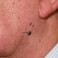 
	Venous lakes
	
	Note the lesion with the…