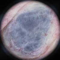 
	Dermoscopic appearance of figure 7

	A…