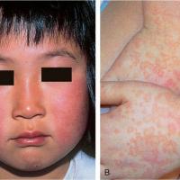 
	Erythema infectiosum

	''Slapped…