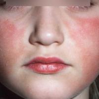 
	Erythema infectiosum