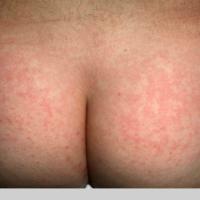 
	Erythema infectiosum