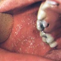 
	Koplik's spots in measles&nbsp;