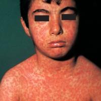
	Measles