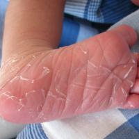 
	Scarlet fever and desquamation