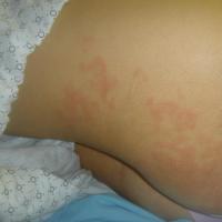 
	Unilateral laterothoracic exanthem