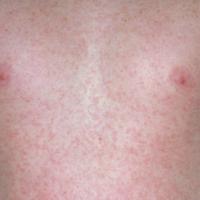 
	Rubella