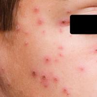 Chickenpox
These lesions have crusted over and…