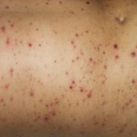 
	Chickenpox