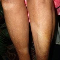 
	Leprosy
	
	Thickened, hypopigmented,…