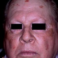 
	Vitiligo - extensive
	
	Only small islands of…