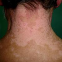 
	Vitiligo - neck