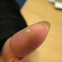 
	Common wart