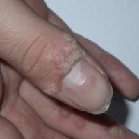 
	Common warts - periungual 