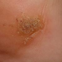 
	Plantar warts 