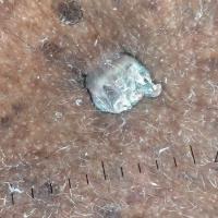 Dermoscopic appearance of a filiform wart
Copied…