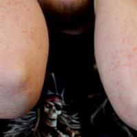 
	Eruptive xanthomata 

	These lesions appeared…