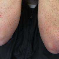 
	Same patient - lesions resolved

	Diabetes and…