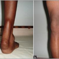 
	Tendon xanthomata