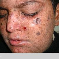 
	Xeroderma pigmentosum 