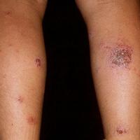 Discoid eczema