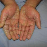 Hand eczema - hyperkeratotic