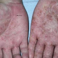 Hand eczema - pompholyx